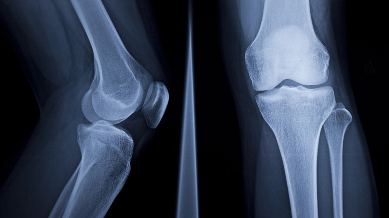 X-ray of a knee bone
