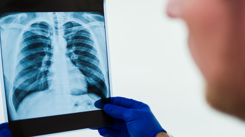 radiologist holding x-ray of ribcage