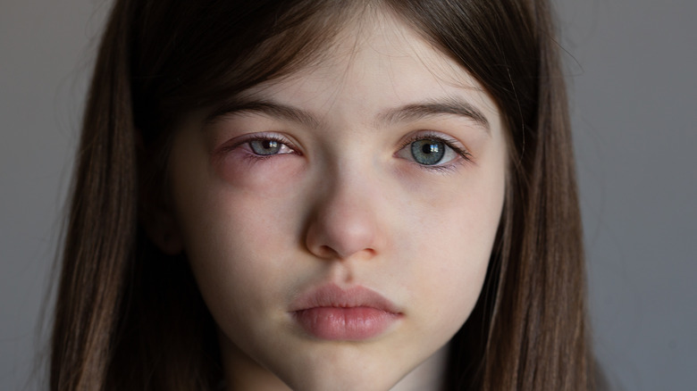Young girl with pink eye