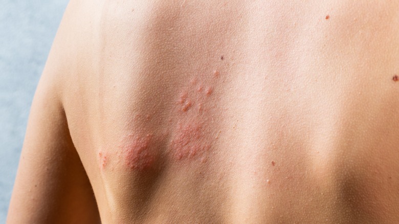 person with shingles