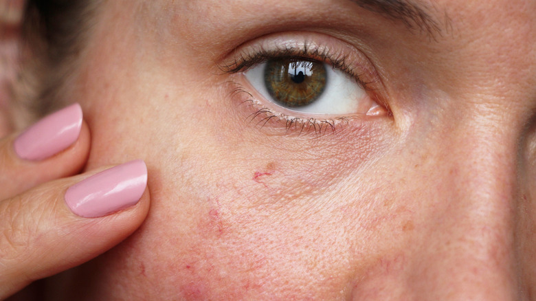 Woman with spider veins on her face