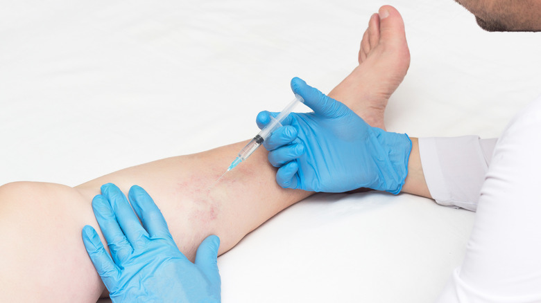 A doctor injecting the varicose veins in woman's leg