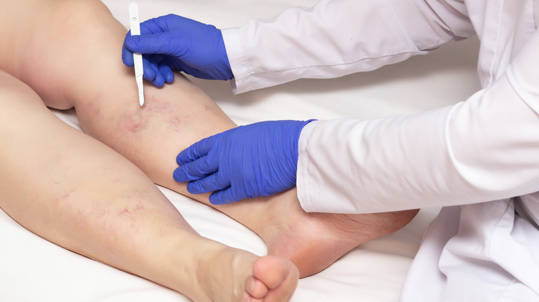 A woman with varicose veins pictured with a doctor holding a scalpel