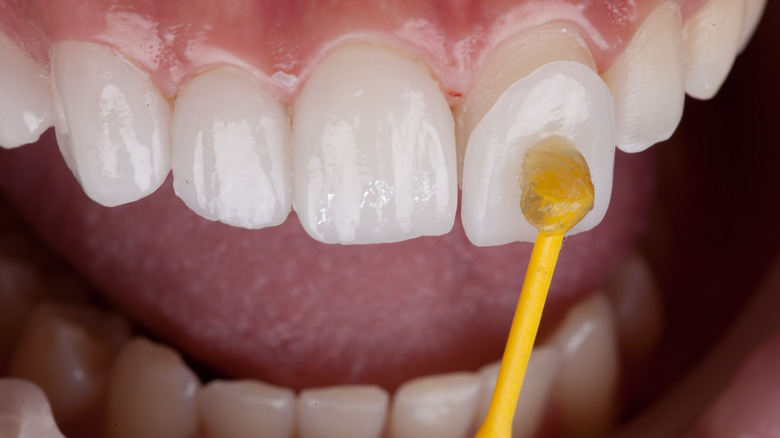 dental veneer procedure 