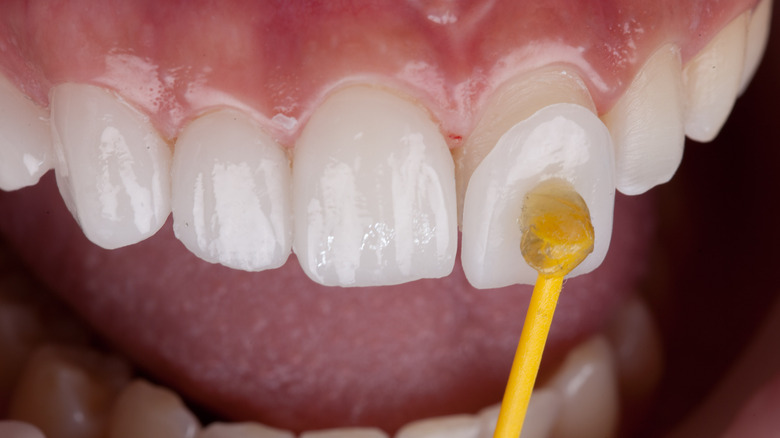 Application of veneers to teeth
