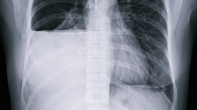 Pneumothorax