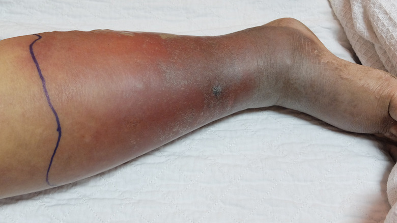 Cellulitis of the foot