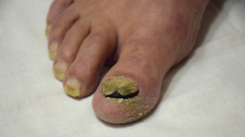 Discolored toenails