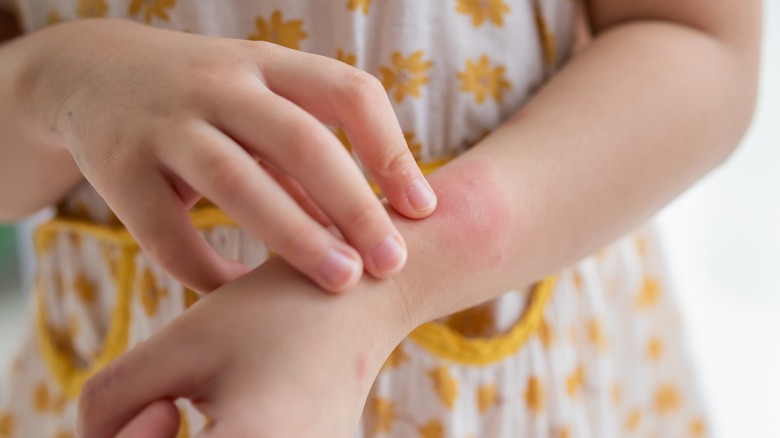 woman with rash on wrist