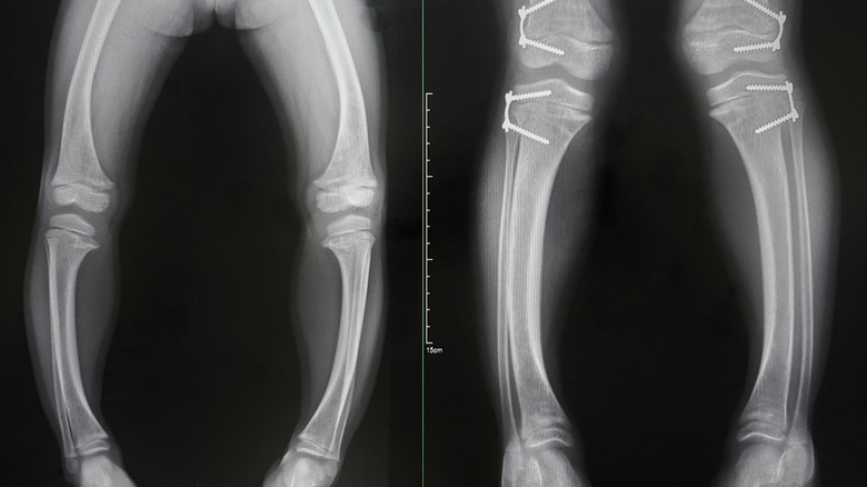 knee deformity