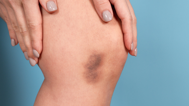 Close up of a woman's bruised leg