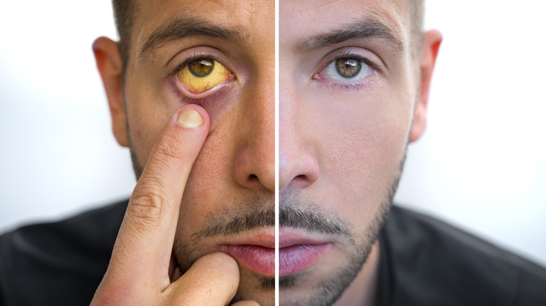 Composite shot of someone before and after jaundice