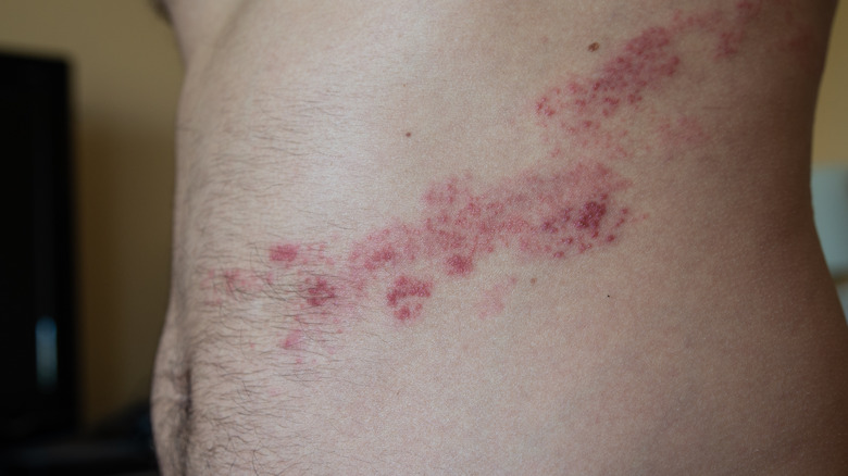 shingles rash on the abdomen