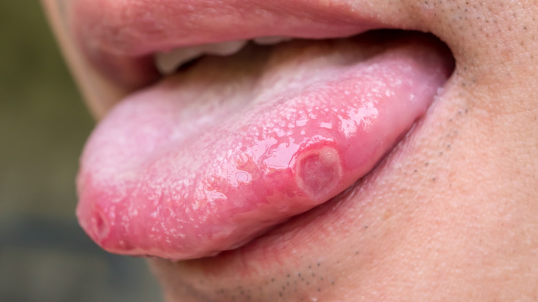 Man with cold sore on the tongue