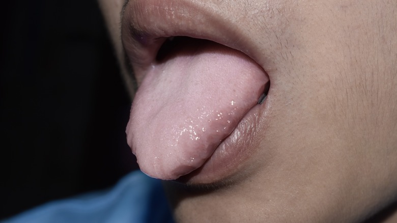 Tongue with enlarged papillae (and coated)