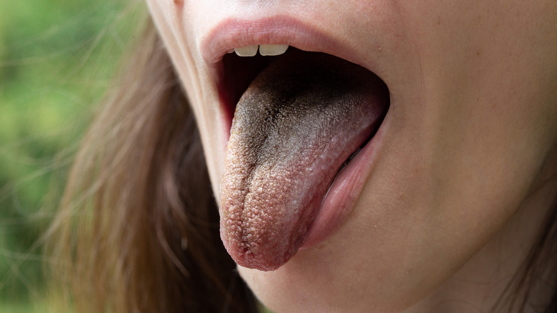 Girl with a black hairy tongue