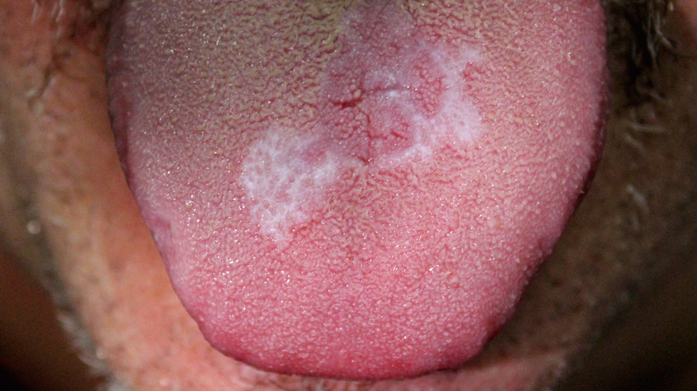 A man with oral lichen planus (lace appearance) on tongue
