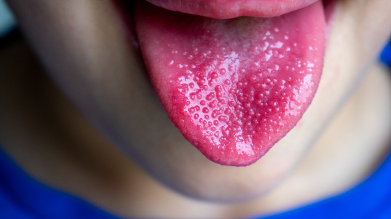 A child with strawberry tongue