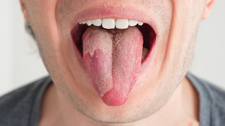 Male showing oral thrush (candida infection) on tongue