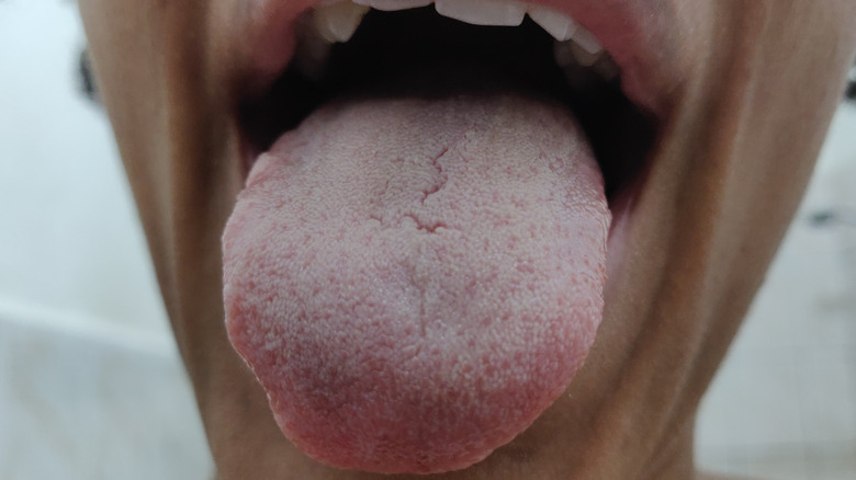 White tongue on women showing sign of dehydration