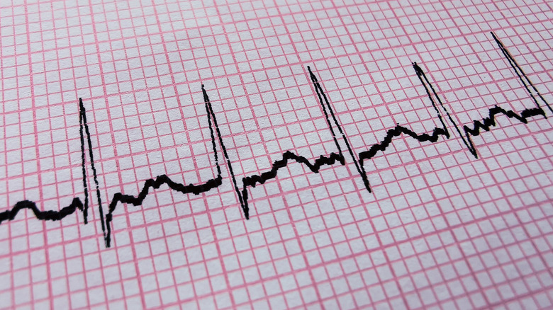 EKG reading of heart experiencing tachycardia