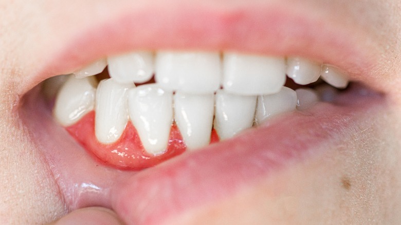 Receding gums from periodontal disease