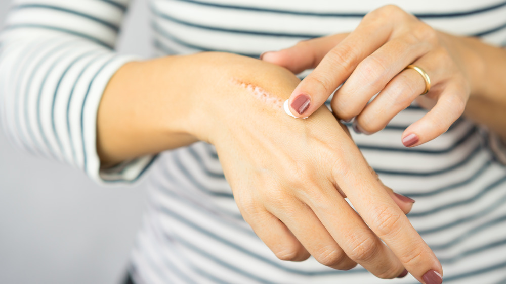 woman applying ointment to wound