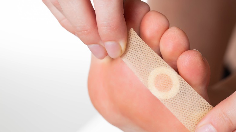 plastering plantar warts