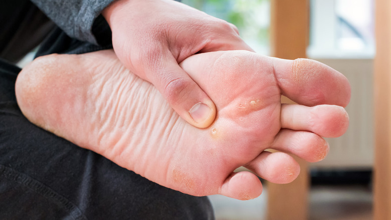 plantar warts under the feet