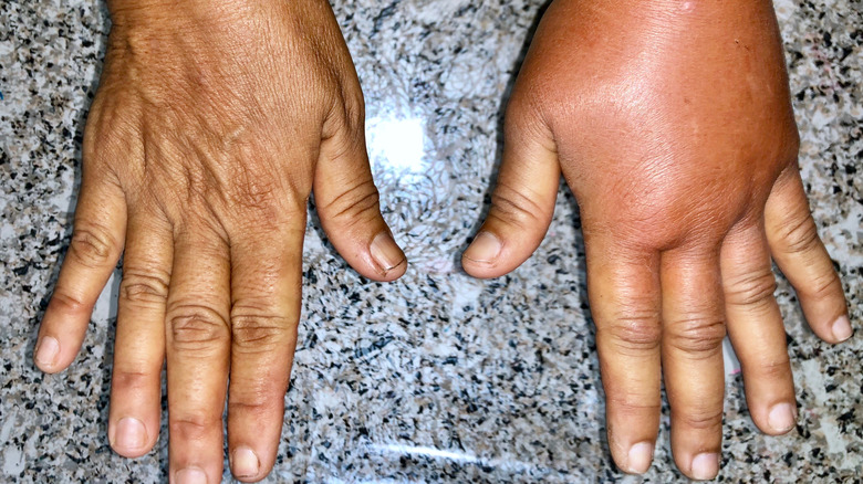 swelling hands caused by lymphedema