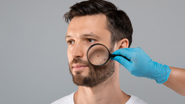 Magnifying glass on a spot on a man's face