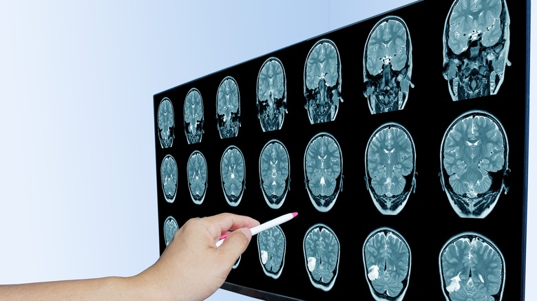 Medical brain scans