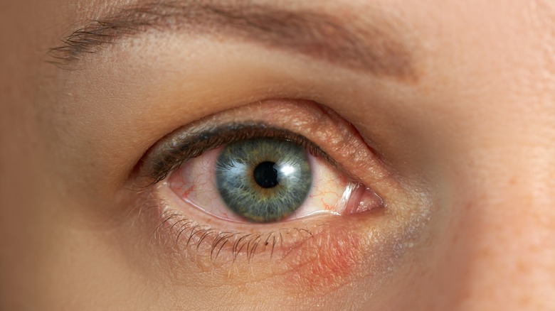 woman with eyelid dermatitis