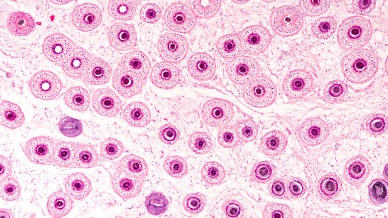 Scalp folliculitis causing bacteria 