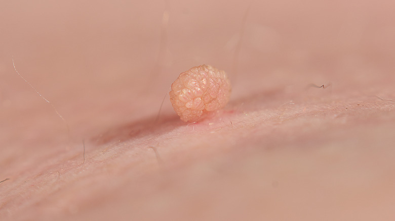 Skin tag on body