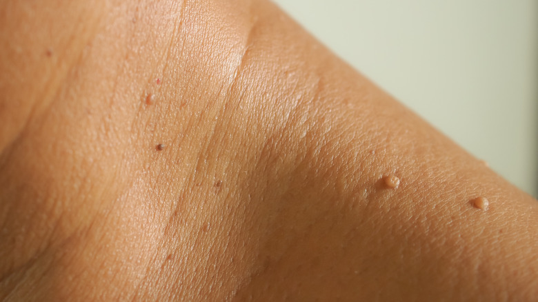 Skin tags on shoulder