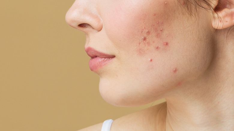 What Causes You To Have Fungal Acne