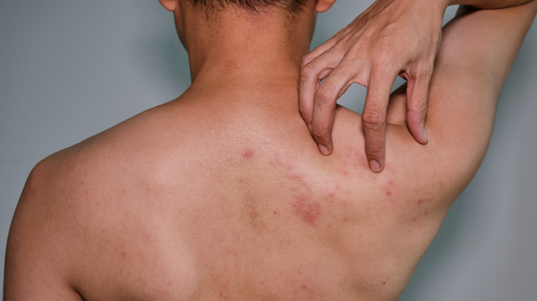 man scratching acne on back