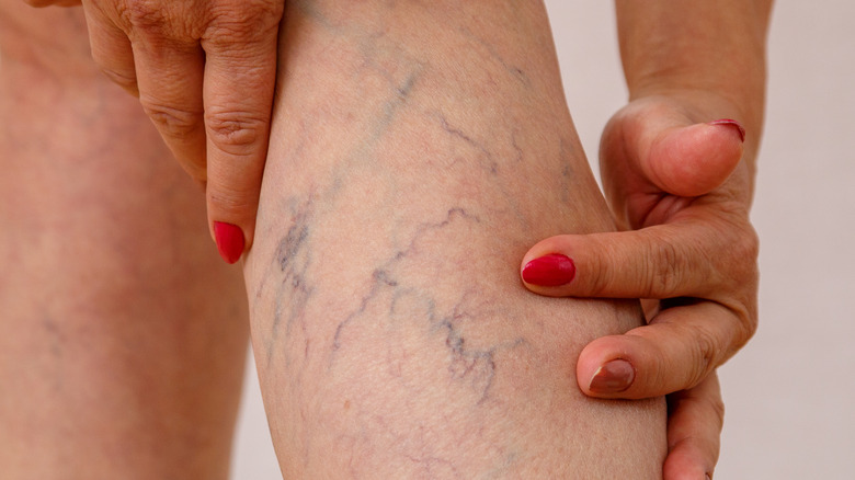 varicose veins on woman's leg