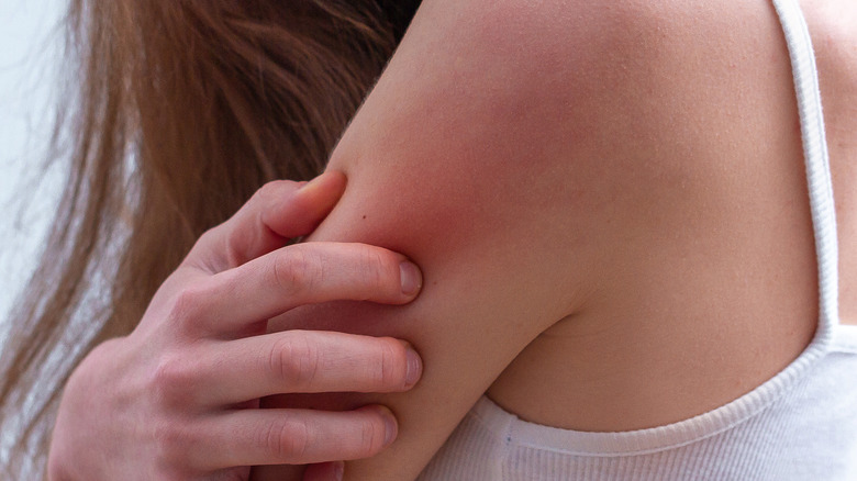 Woman scratching rash on arm