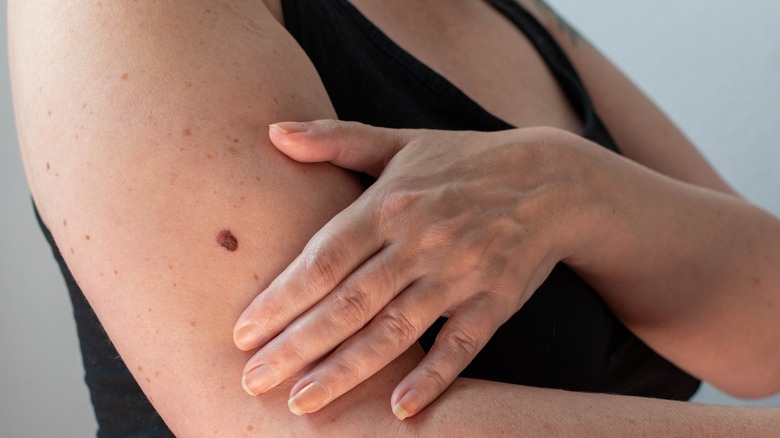 close up of a mole on woman's arm