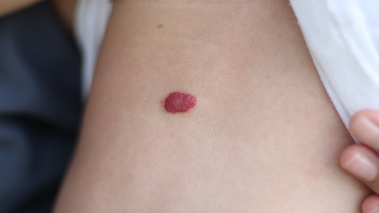 Strawberry hemangioma on child's arm