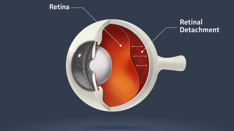 Retina detached from normal position