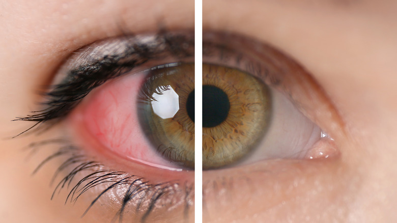 Inflammation and redness of the eye