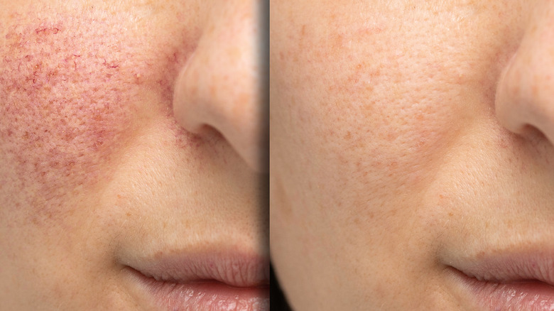 before and after rosacea treatment