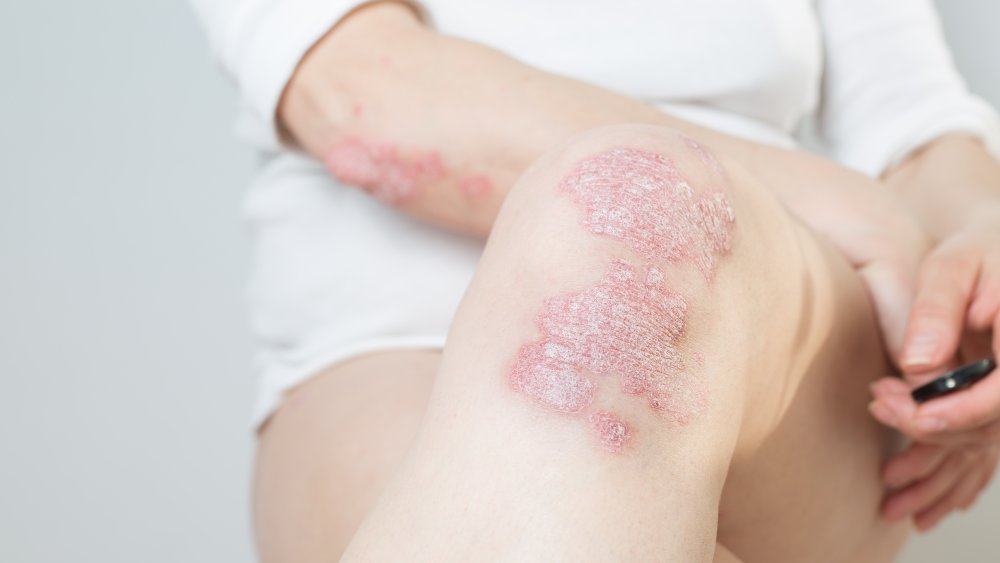 Psoriasis