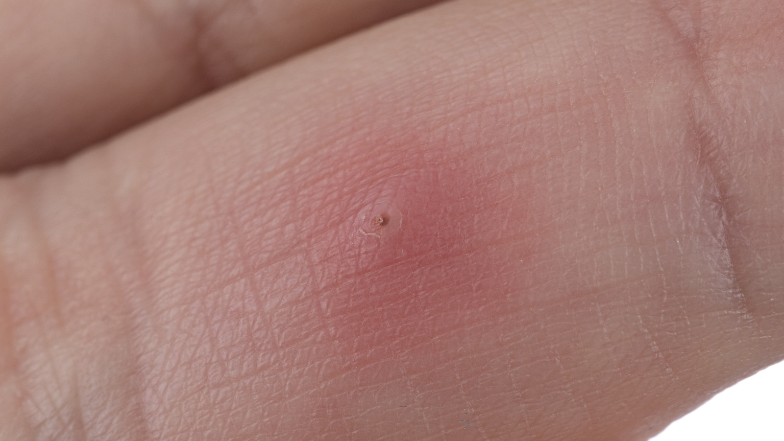 What Happens If A Splinter Goes Untreated 