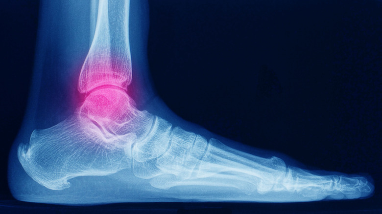 X-ray of injured ankle and foot