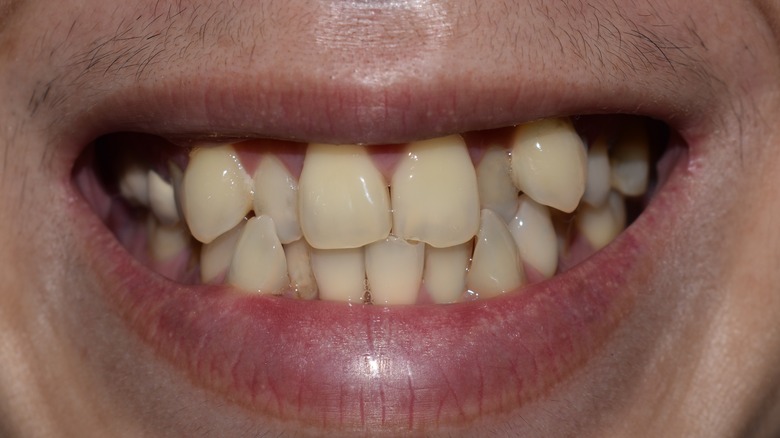 Person with crooked teeth