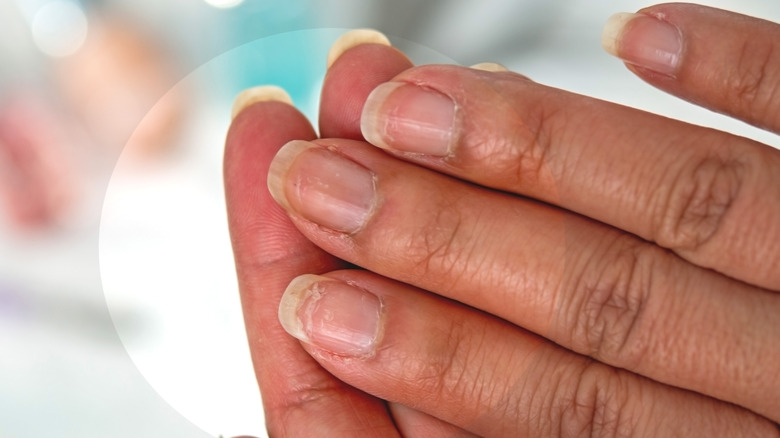 Brittle fingernails